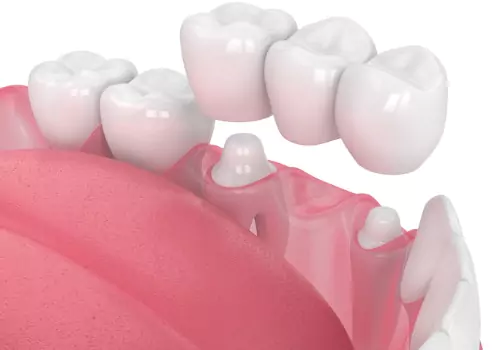 An illustration of dental Crowns & Bridges