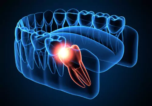 An illustration of an impacted tooth growing in wrong, needing Oral Surgery in Peoria IL