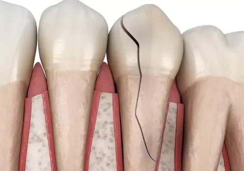 A cracked tooth that requires Emergency Treatment in Peoria IL