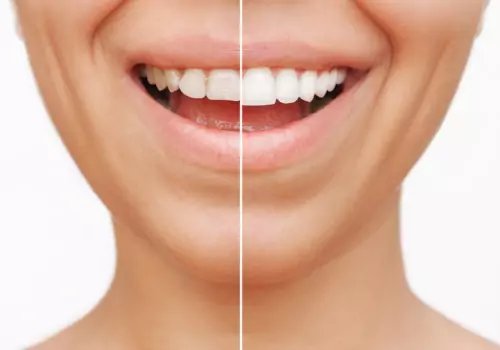 A side by side of a woman's teeth before and after Cosmetic Veneers & Crowns