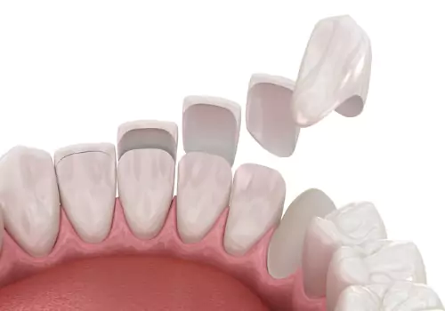 Cosmetic Veneers & Crowns being applied to teeth, as part of an illustration for an important dental procedure