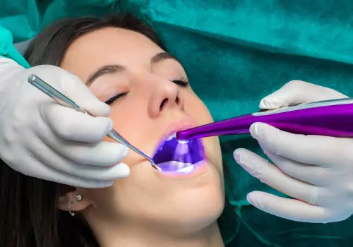 A dentist getting ready to apply Dental Sealants to a patient's mouth in Peoria IL