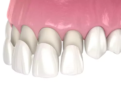 An illustration of crowns being placed on a front row of teeth, part of Full Mouth Reconstruction in Peoria IL