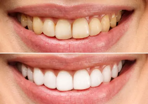 A before and after picture of a woman's teeth after Teeth Whitening in Peoria IL