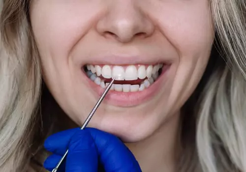 A dentist pointing to white spots on teeth that can be corrected using Icon