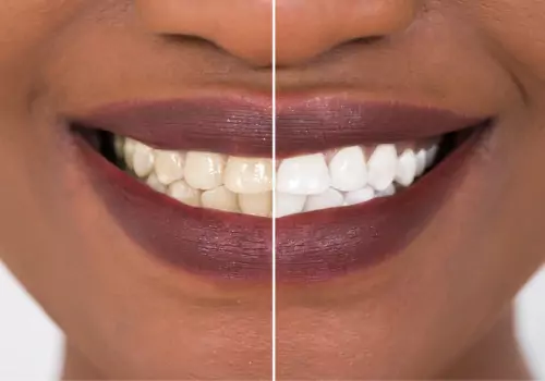 A before-and-after teeth whitening picture is seen. The Smile Center offers teeth whitening in Peoria IL.