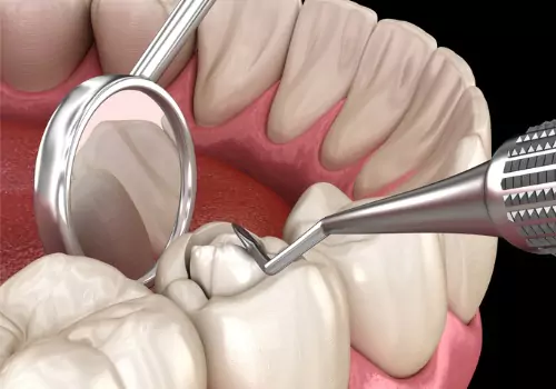 An illustration shows a dental procedure in process. The Smile Center is a holistic dental office in East Peoria IL.