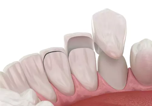 An illustration shows how veneers work. The Smile Center offers dental veneers in Peoria IL.