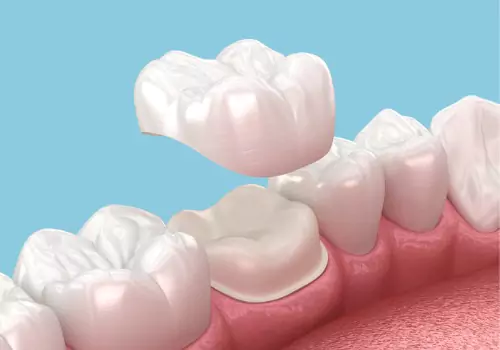 A model of a crown installation is seen. The Smile Center offers dental crowns in Peoria IL.